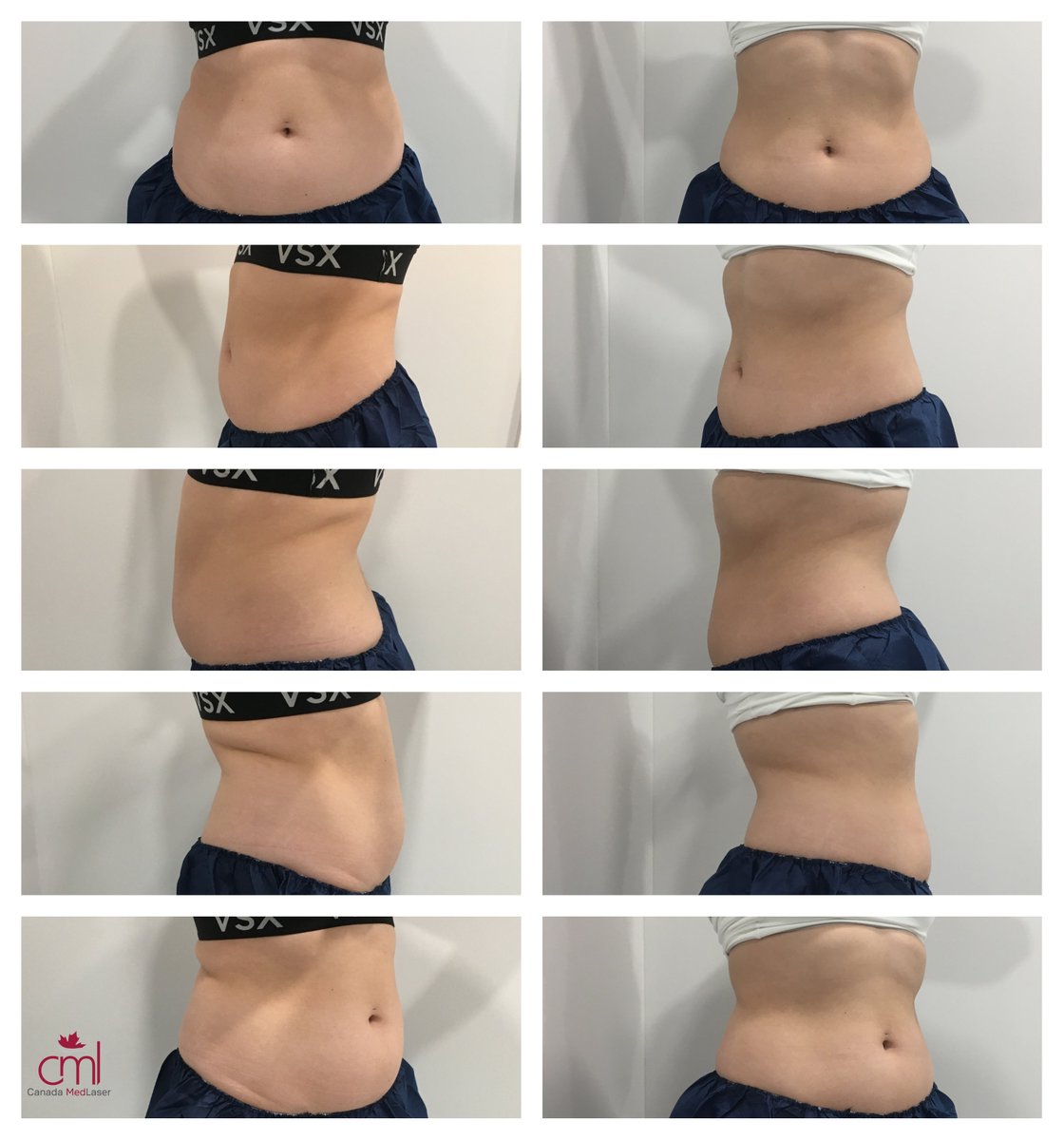 CanadaMedLaser's tweet photo. Amazing @CoolSculpting results for our client that was looking to reduce stubborn fat in abdomen area! #coolsculpting #fatreduction #thursday #toronto #mississauga #vaughan https://t.co/F1G4Qn2OSh