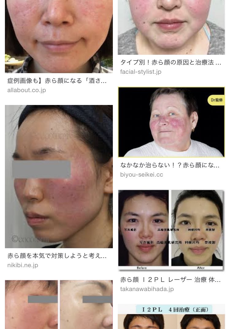 O Xrhsths ごぼ美 Sto Twitter 10代のときやって後悔したこと 眉毛抜く 生えてこないし抜き跡青いまんま 鼻の毛穴パック どれだけケアしても毛穴くぱあ 過剰なピーリング スクラブ 敏感肌と赤ら顔の出来上がり 造顔マッサージ 摩擦でお肌たるんだ