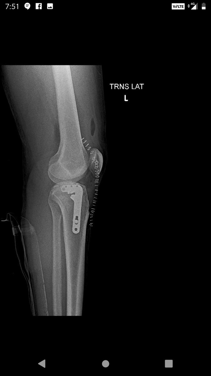 RamanathSharath's tweet photo. Depressed lateral tibial plateau was elevated and fixed with LCP.
releasing of lateral meniscus anterior horn helps in elevation of fragments..
Rafting the fragments prevent s re depression
#fracturesurgery
#tibialplateaufracture https://t.co/60OgjUHWR0