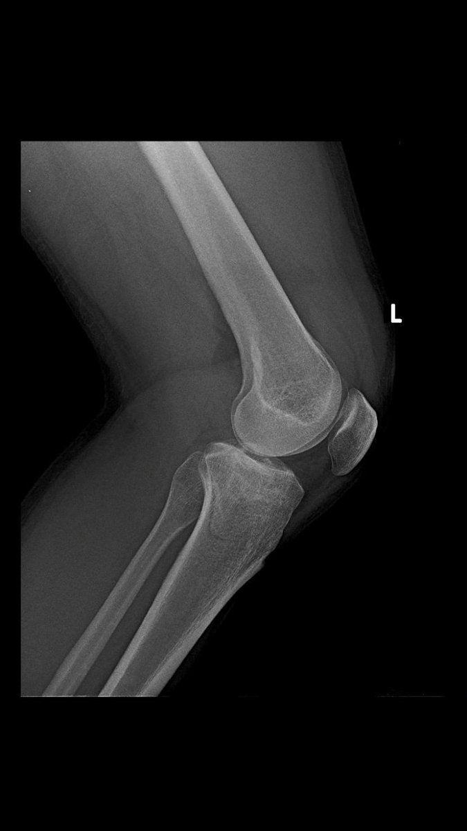 RamanathSharath's tweet photo. Depressed lateral tibial plateau was elevated and fixed with LCP.
releasing of lateral meniscus anterior horn helps in elevation of fragments..
Rafting the fragments prevent s re depression
#fracturesurgery
#tibialplateaufracture https://t.co/60OgjUHWR0