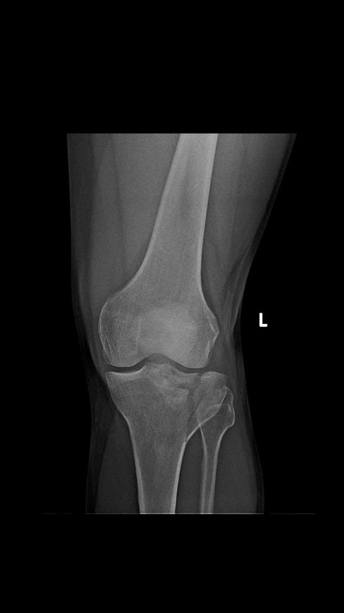 RamanathSharath's tweet photo. Depressed lateral tibial plateau was elevated and fixed with LCP.
releasing of lateral meniscus anterior horn helps in elevation of fragments..
Rafting the fragments prevent s re depression
#fracturesurgery
#tibialplateaufracture https://t.co/60OgjUHWR0