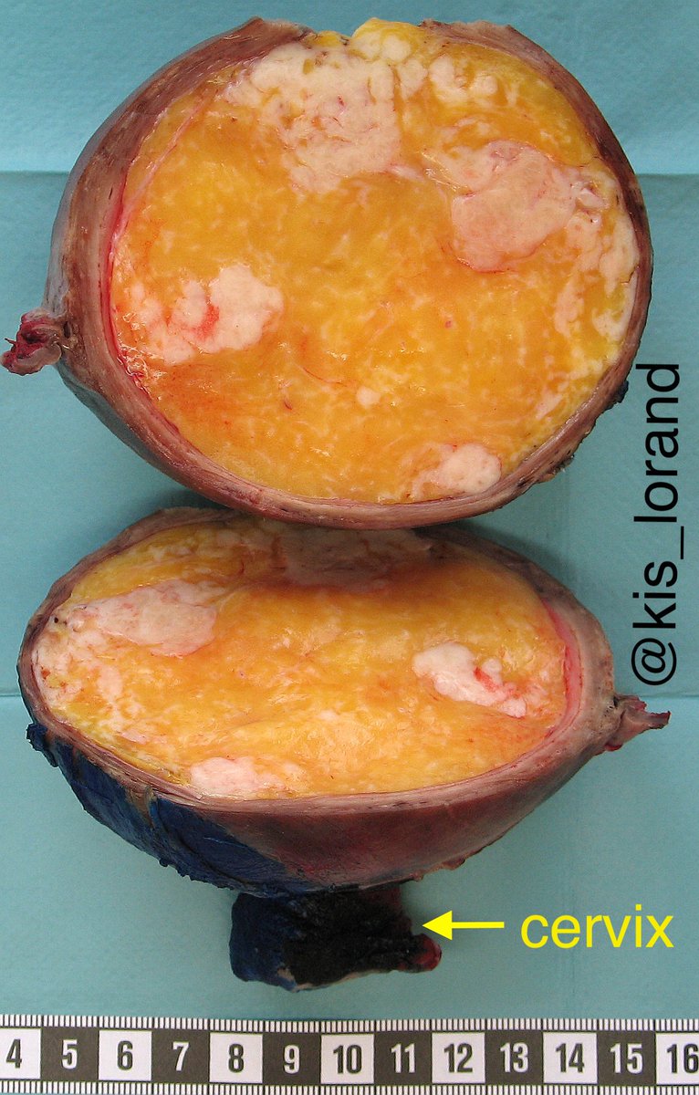 kis_lorand's tweet photo. Let me contribute to the "big specimens' season" with (literally) an orange in the uterus 😀😀 The bonus questions are:
1. what was the preoperative diagnosis in the endometrial biopsy?
2. what did the pathologist do after seeing the biopsy?
#pathology #gynpath https://t.co/jEvN5oAE09