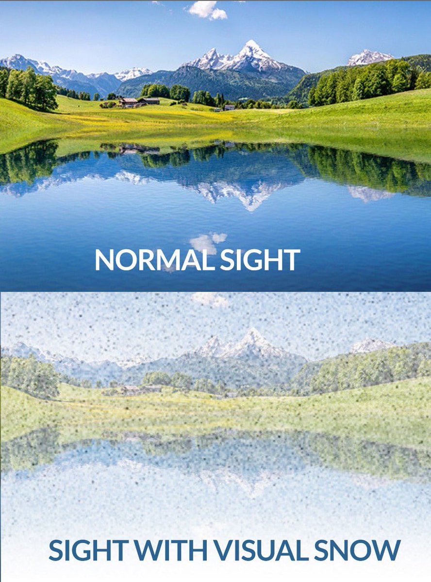 VisualSnowInit's tweet photo. White snowy-like dots in an individual’s field of vision are the main visual symptoms of #VisualSnowSyndrome. However, #VSS is not limited to just visual effects. Find out more about #VisualSnow at https://t.co/Jx9ATGIJm2. 
#VisualSnowAwareness #VisualSnowSupport #VSS #Spoonie https://t.co/CDmueQR4Nx