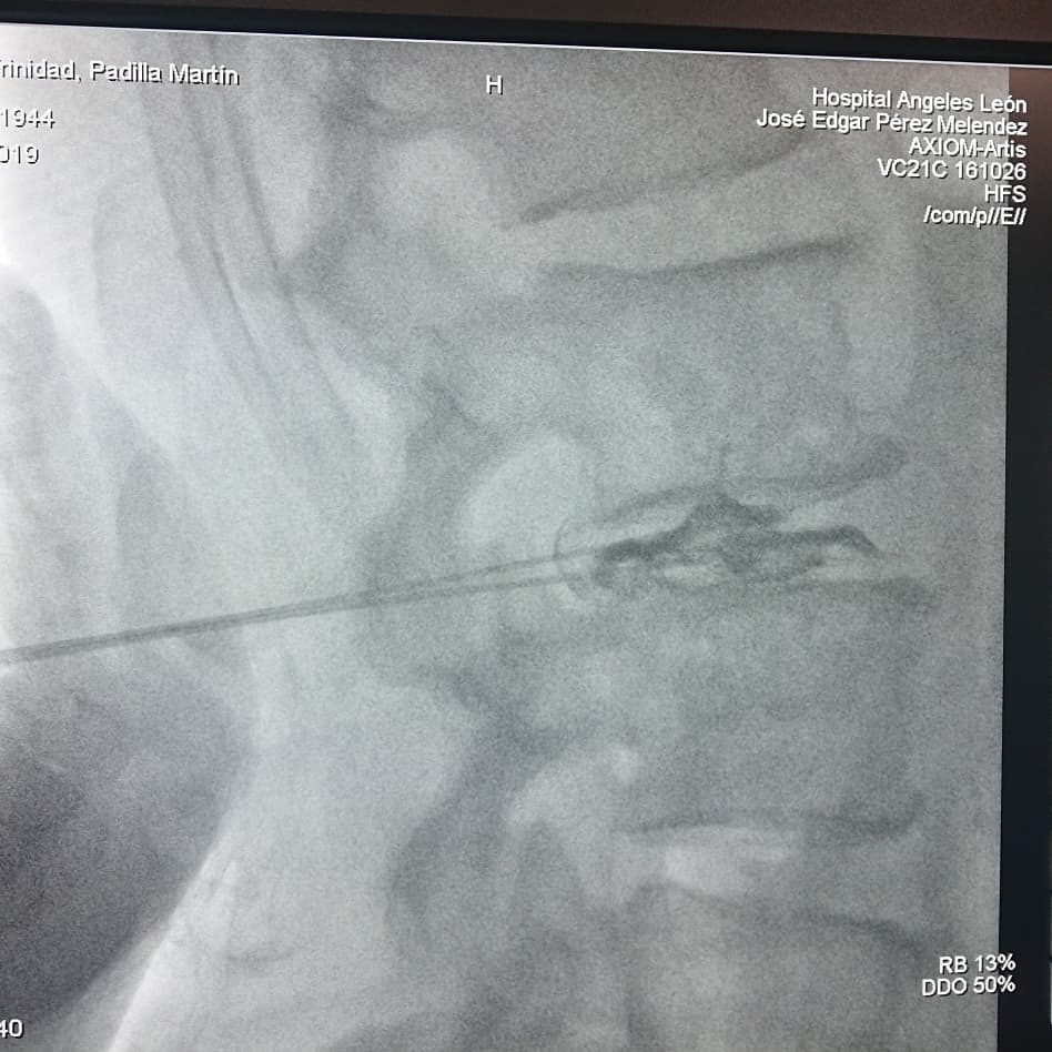 DrBajio's tweet photo. Terminando  biacuplastia para dolor por hernias discales
#VIVESINDOLOR
#ALGOLOGÍA 
#PAINMEDICINE https://t.co/Jrtauro5I6