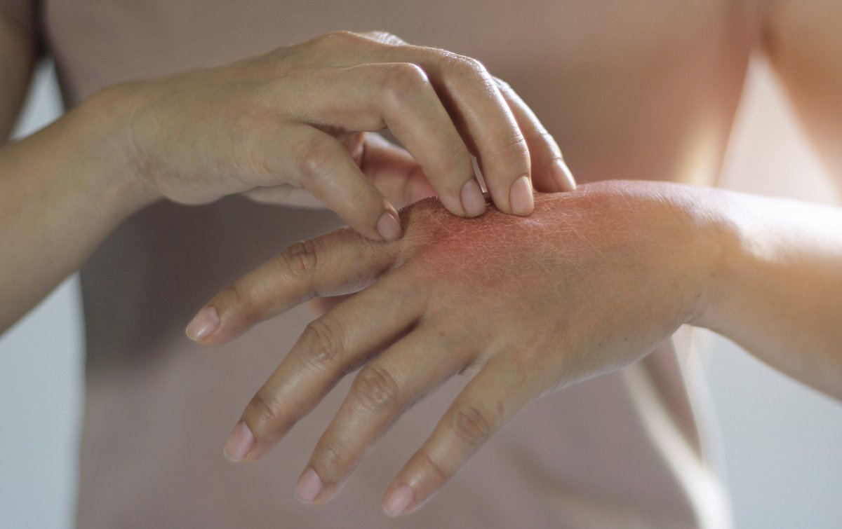 New podcast episode every Thursday at noon! Episode 11 is now available!

Tune into this week’s episode to hear guest Dr. Peter Lio go over Integrative Approaches to Atopic Dermatitis!

learnskin.libsyn.com