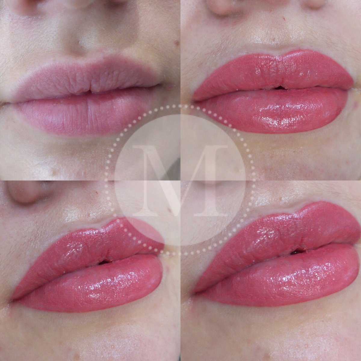 Marcia_MCTS's tweet photo. ๐Semipermanent Lip Blush
๐Even the perfect pout can be perfected!
๐The colour will fade to a natural blush during the healing process. ๐Corrects asymmetry ๐For more information contact
07773229229
Info@marcia.co.uk
#lips #lipvolume #pout #perfectpout #liptattoo https://t.co/AQkecllU1O