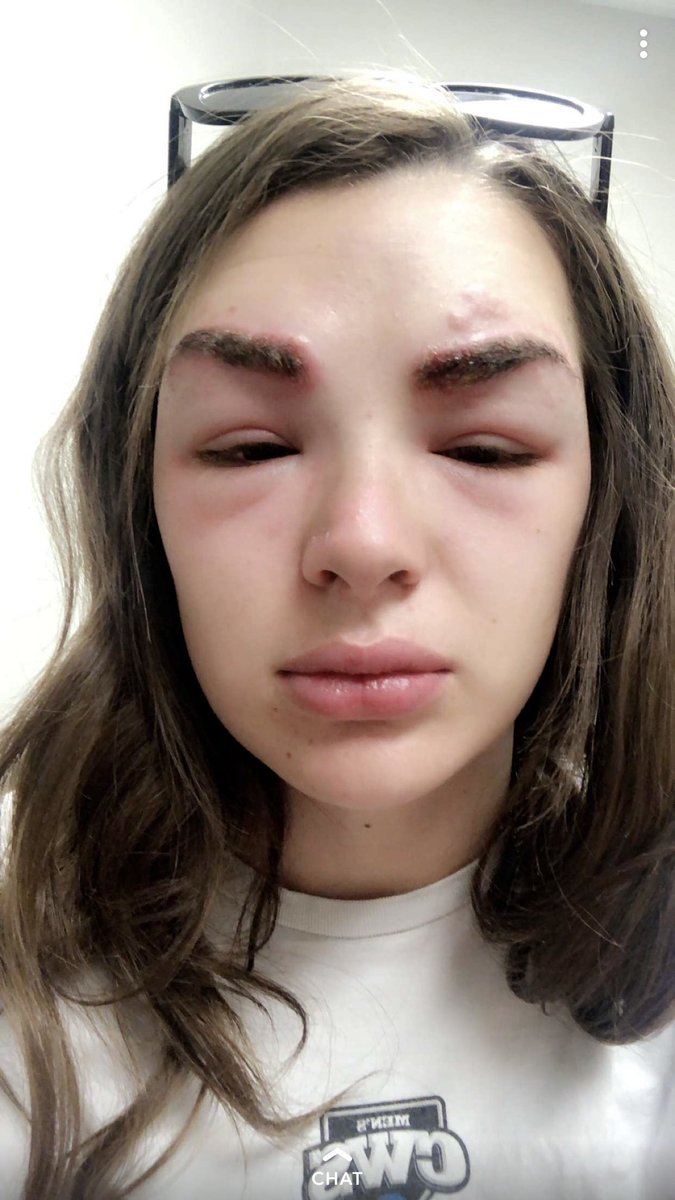 katelyn_ray's tweet photo. @ashlynvanhorn 
WARNING ABOUT THE MEN’S BEARD DYE! My sister and I used the dye after watching your video and unfortunately she ended up with a SEVERE CHEMICAL BURN. After doing some research the company has sever claims against them with the same issue. https://t.co/UVhe5XiX0I