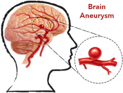 Brain_Disorders's tweet photo. https://t.co/jyJDREhg34

Women more likely to have brain aneurysms than men. How to spot them &amp; treat in time? Get your research work to discuss- Brain 2019

#brain #brainaneurysm #aneurysm #headache #bloodpressure #pain #neurology #Neurosurgery #doctor #hospitals #AI #radiology https://t.co/a0ixzjMYF4