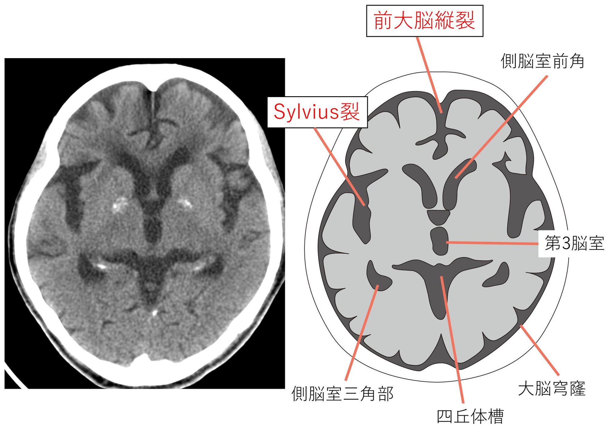 ごろ にゃ 画像診断cafe くも膜下腔の解剖 Sylvius裂 前大脳縦裂 鞍上槽 脳底槽 大脳谷槽 脚間槽 迂回槽 四丘体槽 このあたりを覚えておけば くも膜下出血がある際に どこに血腫があるのかを表現しやすくなります 画像診断 画像