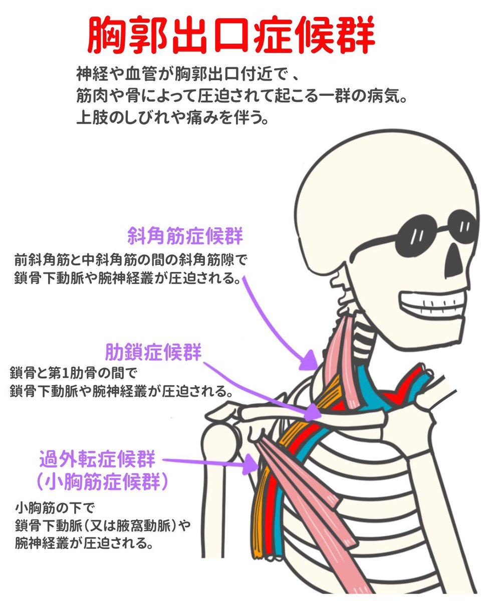 ゴロ 解剖生理イラスト على تويتر イラストで分かる 胸郭出口症候群 イラストで見ると一発で覚えられると思いまっす