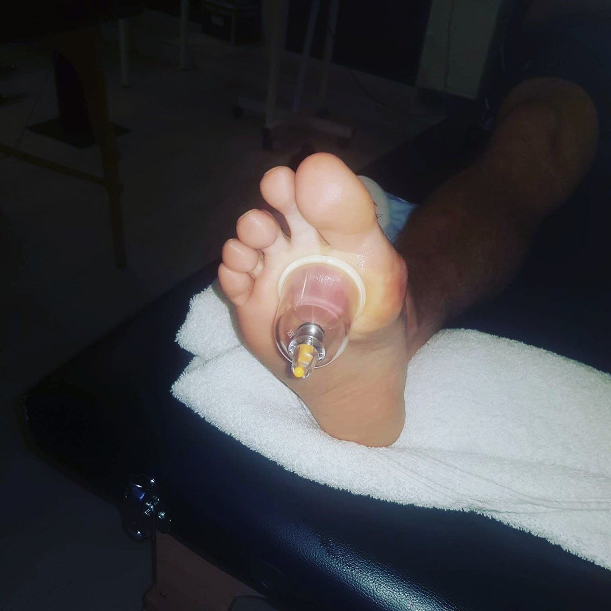 Ttherapy3's tweet photo. My client hasn't been for a while as his foot healed well through cupping therapy but has had to come back for more treatments as he basically has had no help from doctors #Ttherapy #cuppingtherapy #lookafteryourbody #recovery #sportsinjuryrecovery https://t.co/zVVBBERDNp