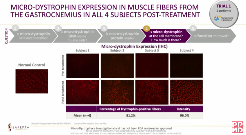 Gantosj's tweet image. $SRPT microD  #ppmdconference