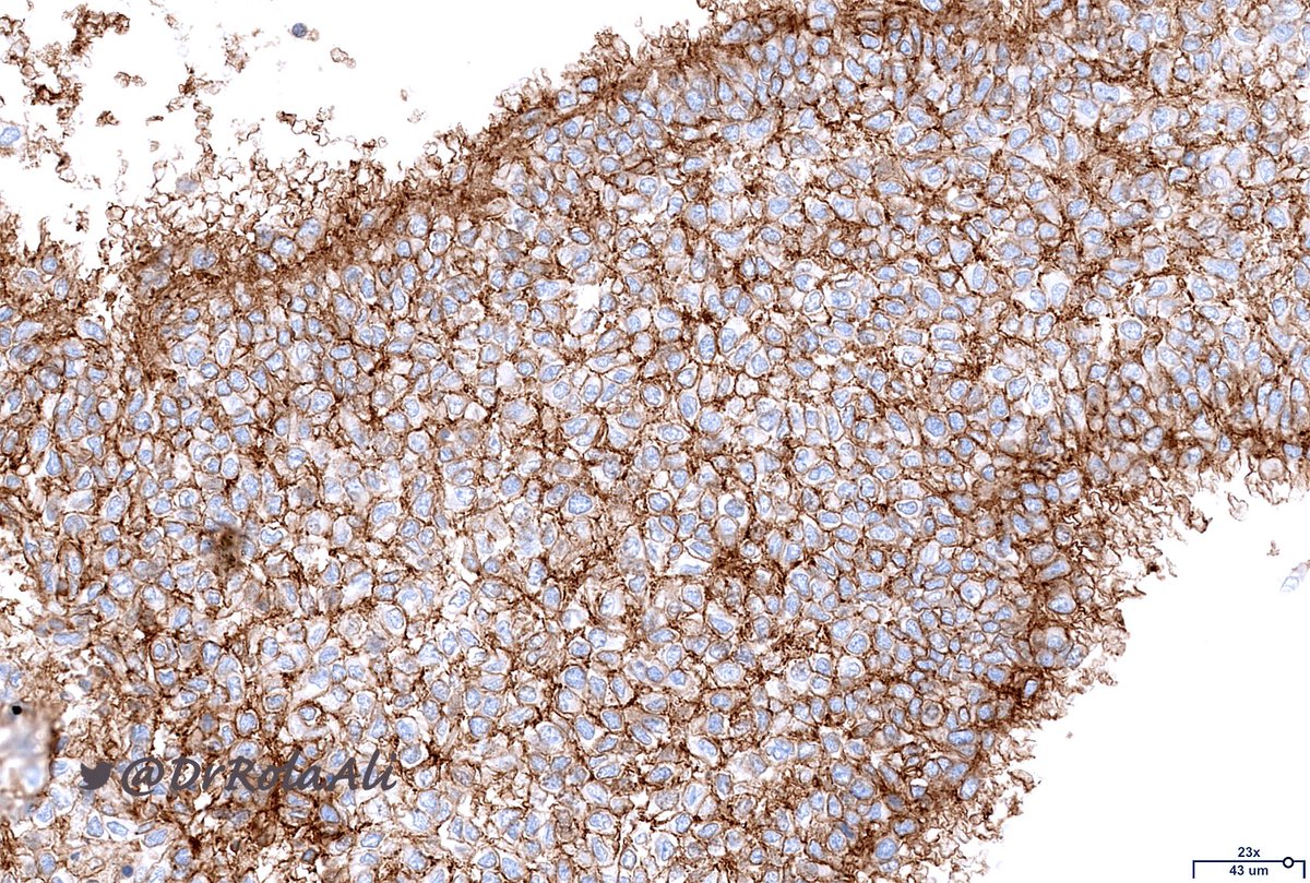2/2 Immunostain shown is CD99 CK and EMA neg FISH: EWSR1 rearrangement 🔬 Superficial Ewing sarcoma Here is a review on superficial ES: ncbi.nlm.nih.gov/m/pubmed/23327… And another one on cutaneous/superficial neoplasms with EWSR1 rearrangement: ncbi.nlm.nih.gov/m/pubmed/23399… #BSTPath