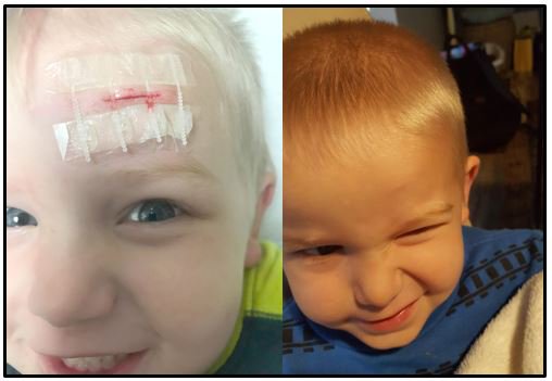 I decided to have the Zip used on my child because I would much prefer this device than a shot to my child’s head; that would be traumatic for me and probably for him too.  - Danielle Hollis – mother of Diesel (2 ½-year-old)
ziplinemedical.com/patient-zip/