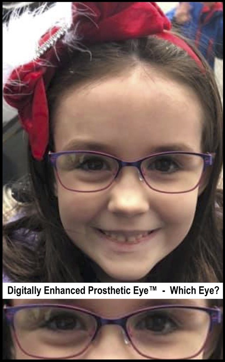 Which Eye...?

#EstheticEyes #Macrophthalmia #Microphthalmia #ArtificialEyes #BestArtificialEyes #BestProstheticEyesUSA #BestProstheticEyesWorldwide #ProstheticEyes #AdvancedProstheticEyeTechnology #MAPS #MAPSMOMS