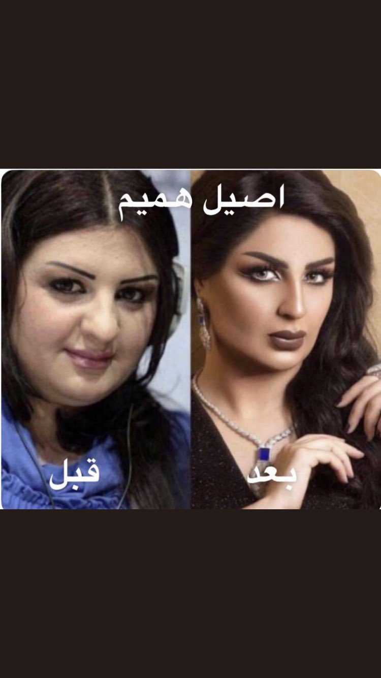 عمليات قبل اصيل التجميل هميم تعرف على