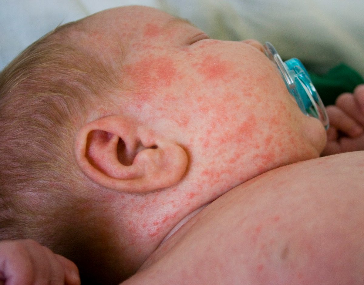 Pediatricslarix's tweet photo. MILIARIA #pediatric #dermatology 
To know more about it please attend the World #Congress on #Obstetrics, #Gynecology &amp; #pediatrics 2019, #Singapore

Register for 4 and get 1 registration absolutely FREE !!

Visit: https://t.co/qVSTwfQLG9

#pediatrics2019 @MDedgePediatric #child https://t.co/sjY48unUYK