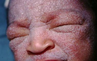 Pediatricslarix's tweet photo. MILIARIA #pediatric #dermatology 
To know more about it please attend the World #Congress on #Obstetrics, #Gynecology &amp; #pediatrics 2019, #Singapore

Register for 4 and get 1 registration absolutely FREE !!

Visit: https://t.co/qVSTwfQLG9

#pediatrics2019 @MDedgePediatric #child https://t.co/sjY48unUYK