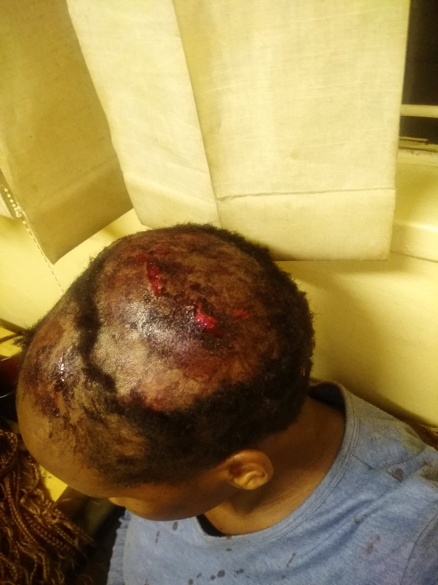 iam_ayamah's tweet photo. I wasn't Gona post this because I wanted to give the SAPS at Jabulani the benefit of doubt, but yet again they disappoint me! My 28year old male cousin, his mother and  his father did this to me! @SAPoliceService ...full story below... https://t.co/RCvo4BrXbX