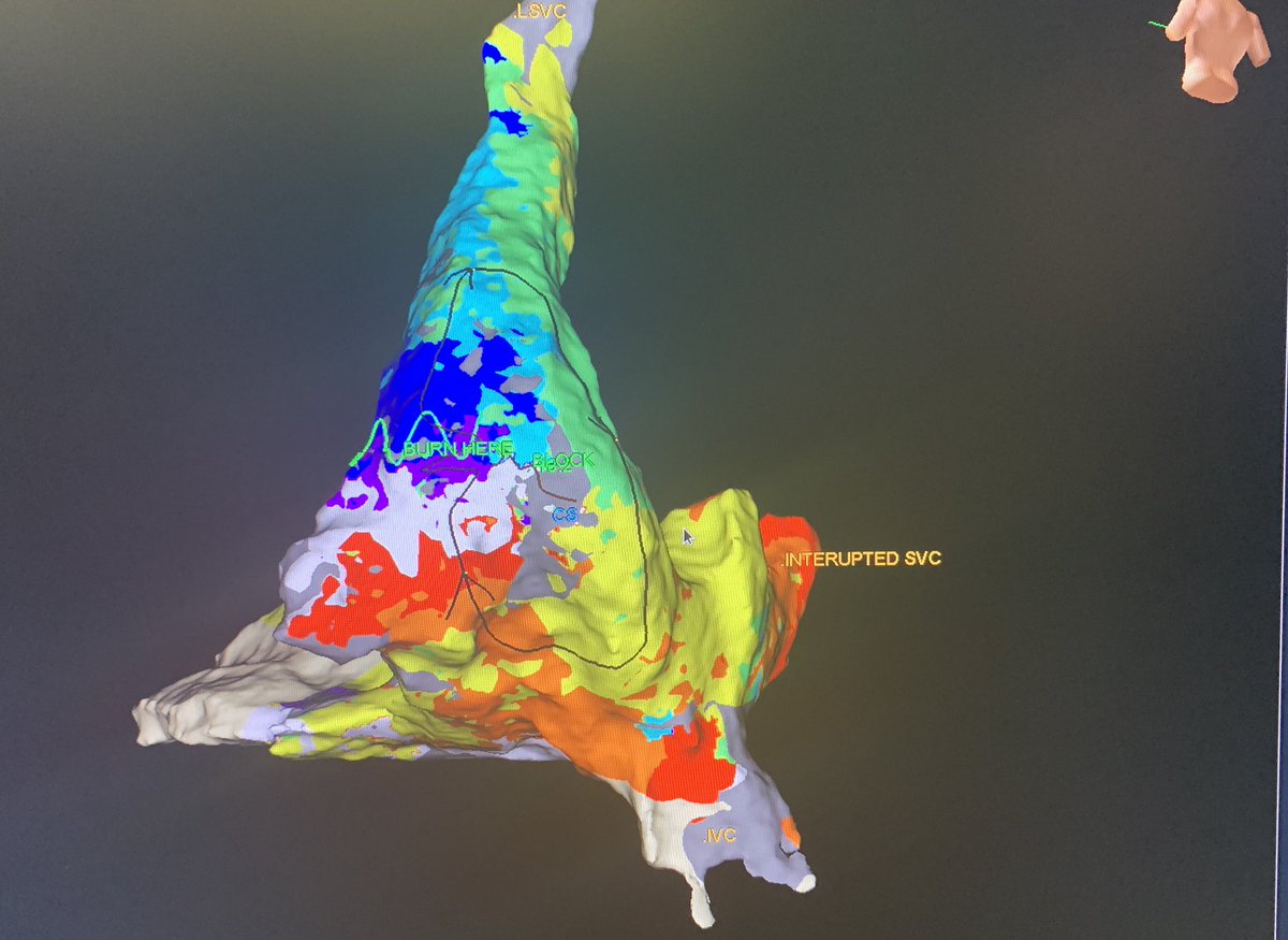 MonicaYLo's tweet image. PLSVC is common; PLSVC w/o right SVC (isolated SVC) and a GIANT coronary sinus isn’t. This aneurysmal CS is like another cardiac chamber. Flutter termination in a patient with history of CABG. #mapmoreburnless #EPeeps #HDGrid #atypicalflutter #JustATypicalDayinEP @ArHeartHospital