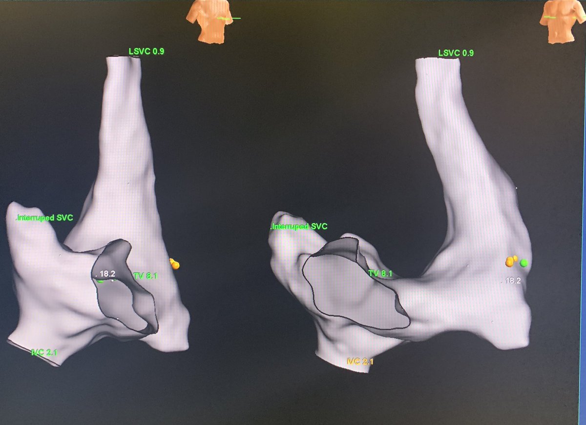 MonicaYLo's tweet image. PLSVC is common; PLSVC w/o right SVC (isolated SVC) and a GIANT coronary sinus isn’t. This aneurysmal CS is like another cardiac chamber. Flutter termination in a patient with history of CABG. #mapmoreburnless #EPeeps #HDGrid #atypicalflutter #JustATypicalDayinEP @ArHeartHospital
