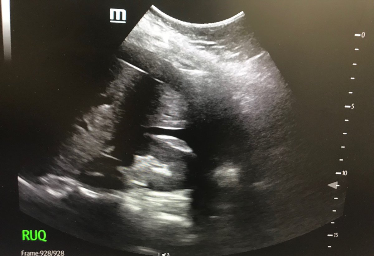 SmallsSono's tweet photo. Interns: Welcome to EM! Sometimes it’s as simple as a young girl coming in with sudden onset lower belly pain and a quick #POCUS that shows free fluid #rupturedectopic @CleClinicMD @MetroHealth_EM #internlearning #meded https://t.co/vMX3uVav3U