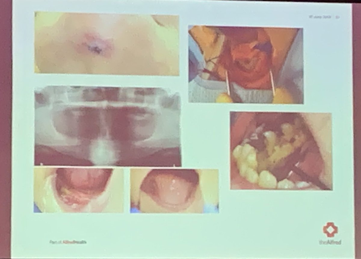 pguthreyRx's tweet photo. “You may think you’re not qualified to look into someone’s mouth - but you’ve all seen my pictures today and you know they are not normal and need to be referred to a dentist” Dr Matthew Lim
Advocate for and encourage oral health in older people.
#ConPharm #ConPharm19 https://t.co/3C0eXVe35Z