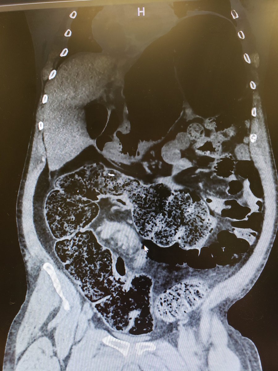 GIDrDon's tweet photo. Sigmoid volvulus....emergent endoscopic decompression is the treatment of choice before definitive surgical therapy. #volvulus #endoscopicdecompression #giemergency #MedEd https://t.co/75iVjr46NI