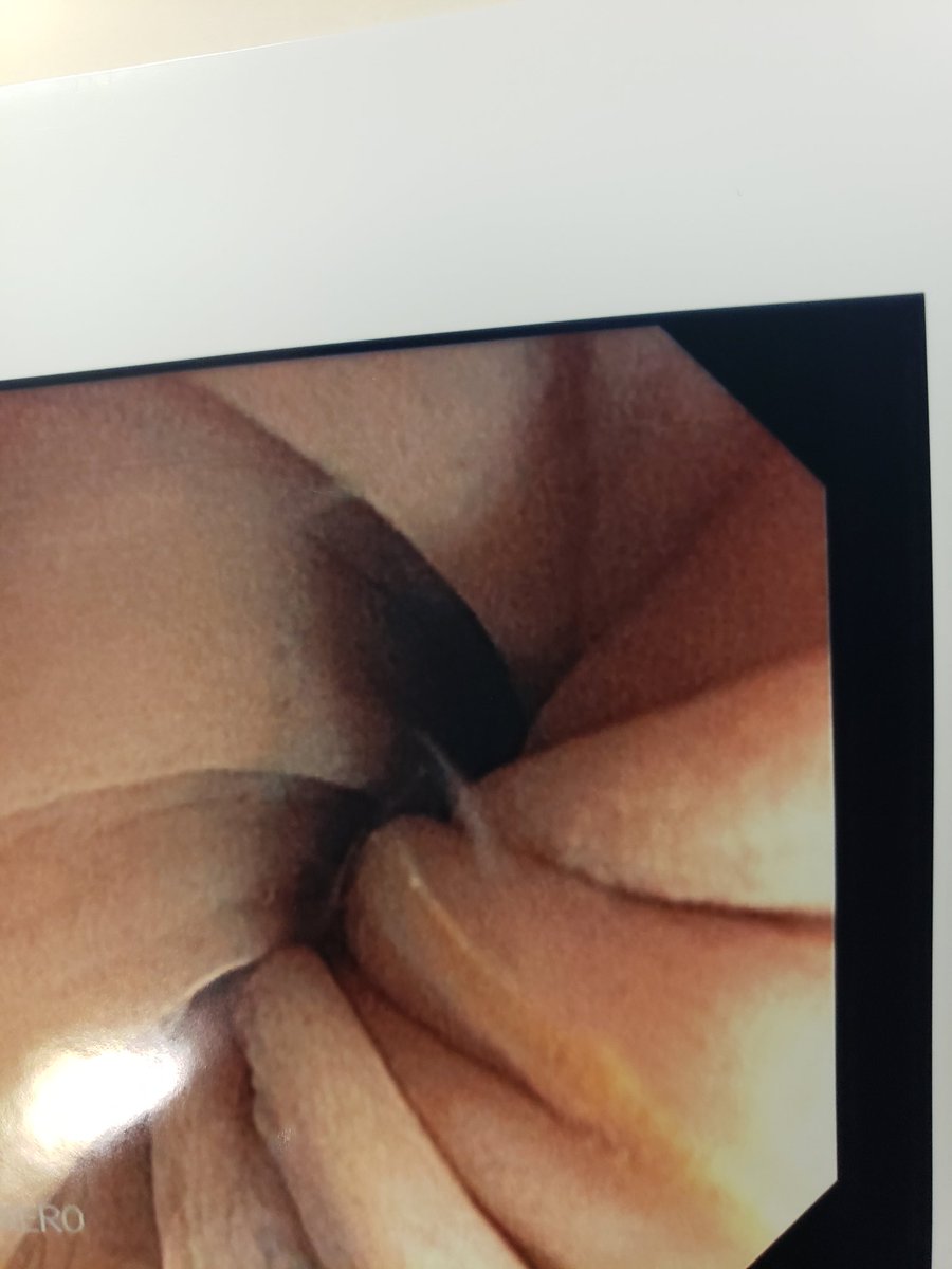 GIDrDon's tweet photo. Sigmoid volvulus....emergent endoscopic decompression is the treatment of choice before definitive surgical therapy. #volvulus #endoscopicdecompression #giemergency #MedEd https://t.co/75iVjr46NI