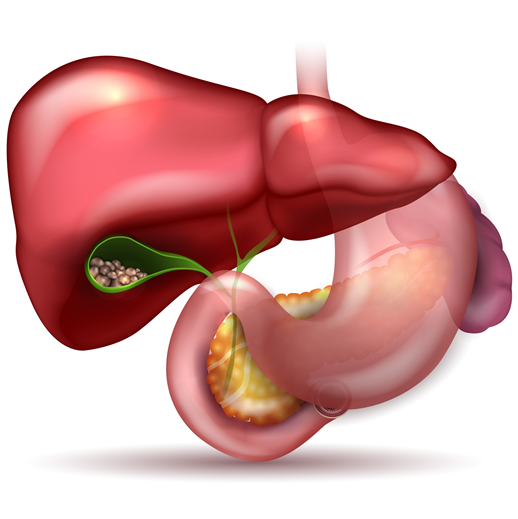 FructoseNo's tweet image. Gallstones &amp;amp; cholecystitis likely to be caused by low fat diets. Decades of low fat mean gallbladder hasn't been squirting out bile acid to dissolve ingested fat. Sludge➡️stones➡️pain/surgery. Another condition caused by bad advice to cut #fat. ncbi.nlm.nih.gov/pmc/articles/P… #Yes2Meat