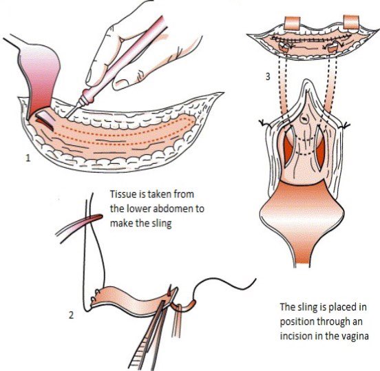 chuikalun1's tweet photo. #NoMesh era 

Do no harm

The autologous #TVT graft is the best solution https://t.co/X112jglFYO