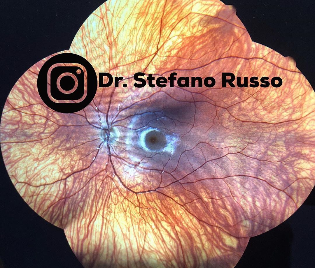 Reposting @dr.stefanorusso:
'Choroideremia #choroideremia #choroid #retinaldystrophy #retina #posteriorsegment #slitlamp #fundus #fundusphotography #slitlampexamination #optometry #ophthalmology #ophthal #medicine #eyespecialist #eyemedicine #eyesurgeon #myophthalmologyresidency'