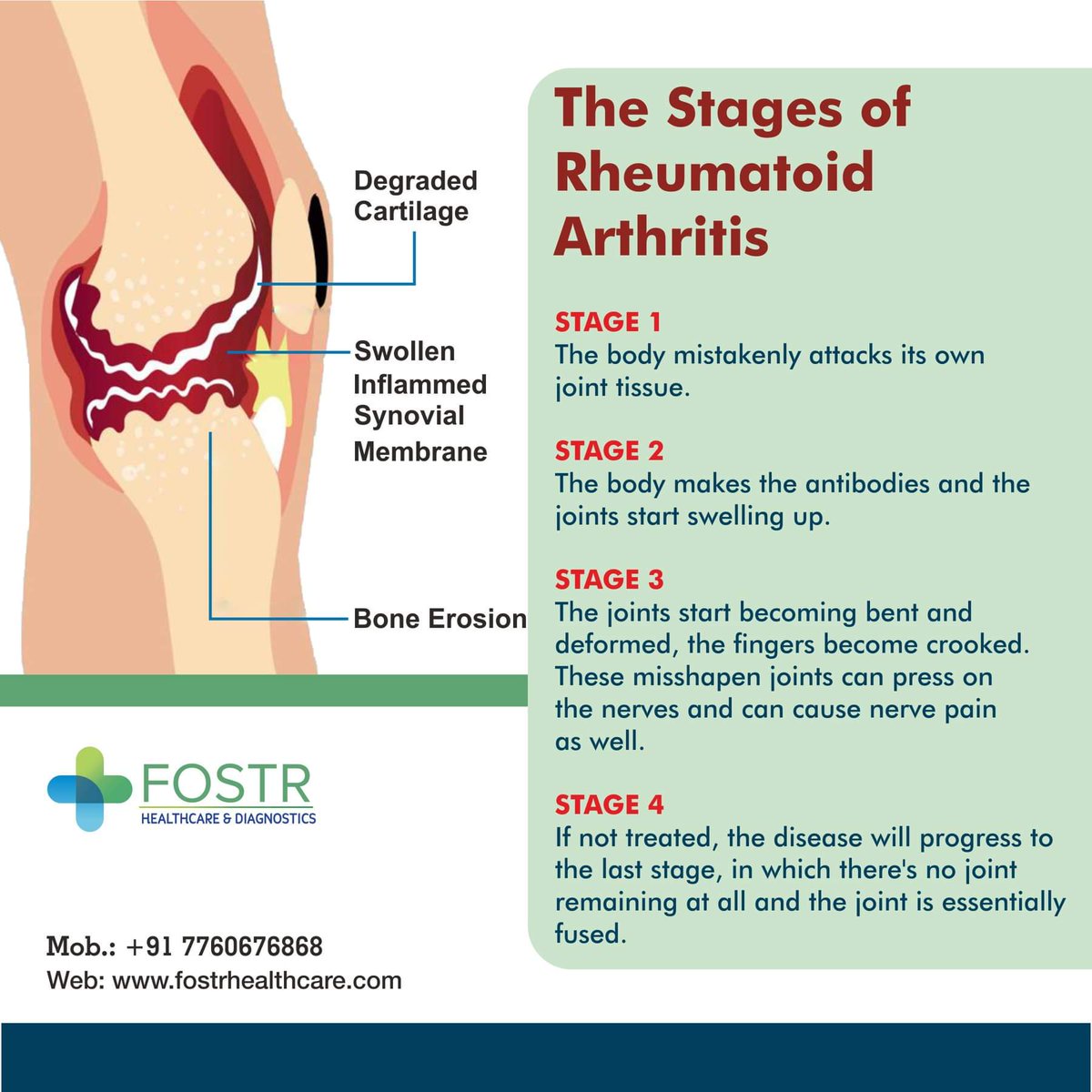 Rheumatoid arthritis 4 stages