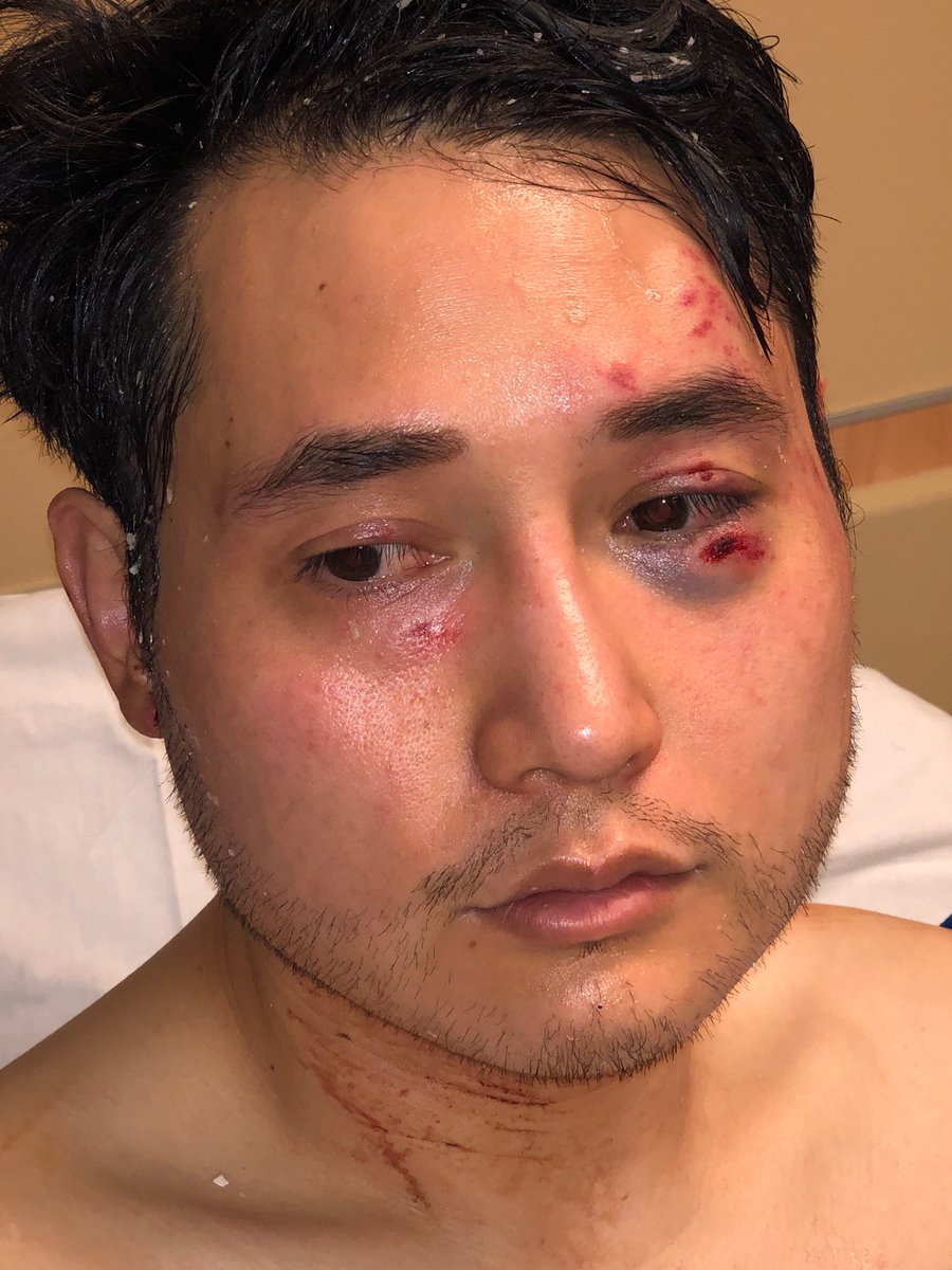 Andy Ngo suffering issues with memory and speaking after AntiFA attack - may have brain damage