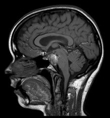 ESERadiology's tweet photo. ESER Case of the Month: young female presents with sudden onset headache - what is happening? Tweet us your answers #Emergency #radiology #ESERcaseofthemonth https://t.co/CE6rZSbptG