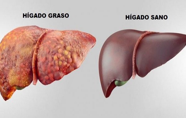 #HígadoGraso. #Alcohol, #sobrepeso y #sedentarismo, los responsables de la '#Pandemia del nuevo siglo'. Expertos alertaron q las #enfermedades hepáticas afectan a 2 de c/5 #argentinos y en 2030 el HG causará+#cáncer q la #Hepatitis: proyecto-salud.com.ar/shop/detalleno…
#Medicina #salud