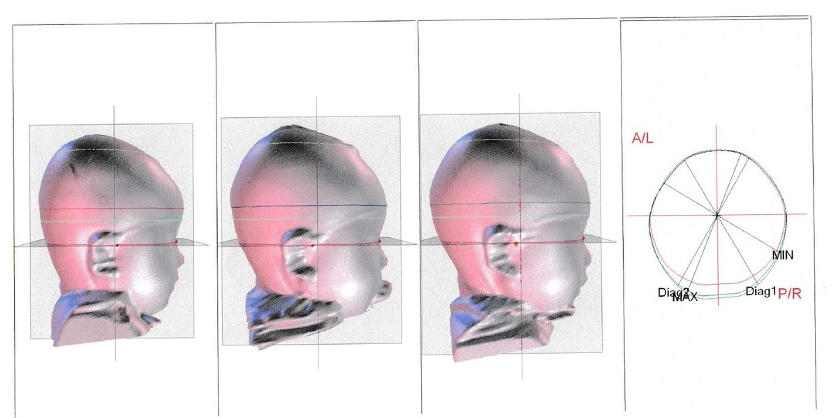 中吉h うちの子が頭の形を良くするヘルメットを6ヶ月付けた成果はこちら 左の絶壁から 真ん中が３ヶ月 右は六か月 かなり 綺麗な形になりました