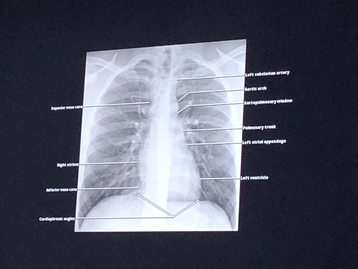 STRS_Evelina's tweet photo. Some fantastic #STRStips from our #Pediatric #radiology team on #CXR interpretation- #anatomy & surface markings
#PedsICU #PedCICU #PedEm https://t.co/WkF3QCFgL1