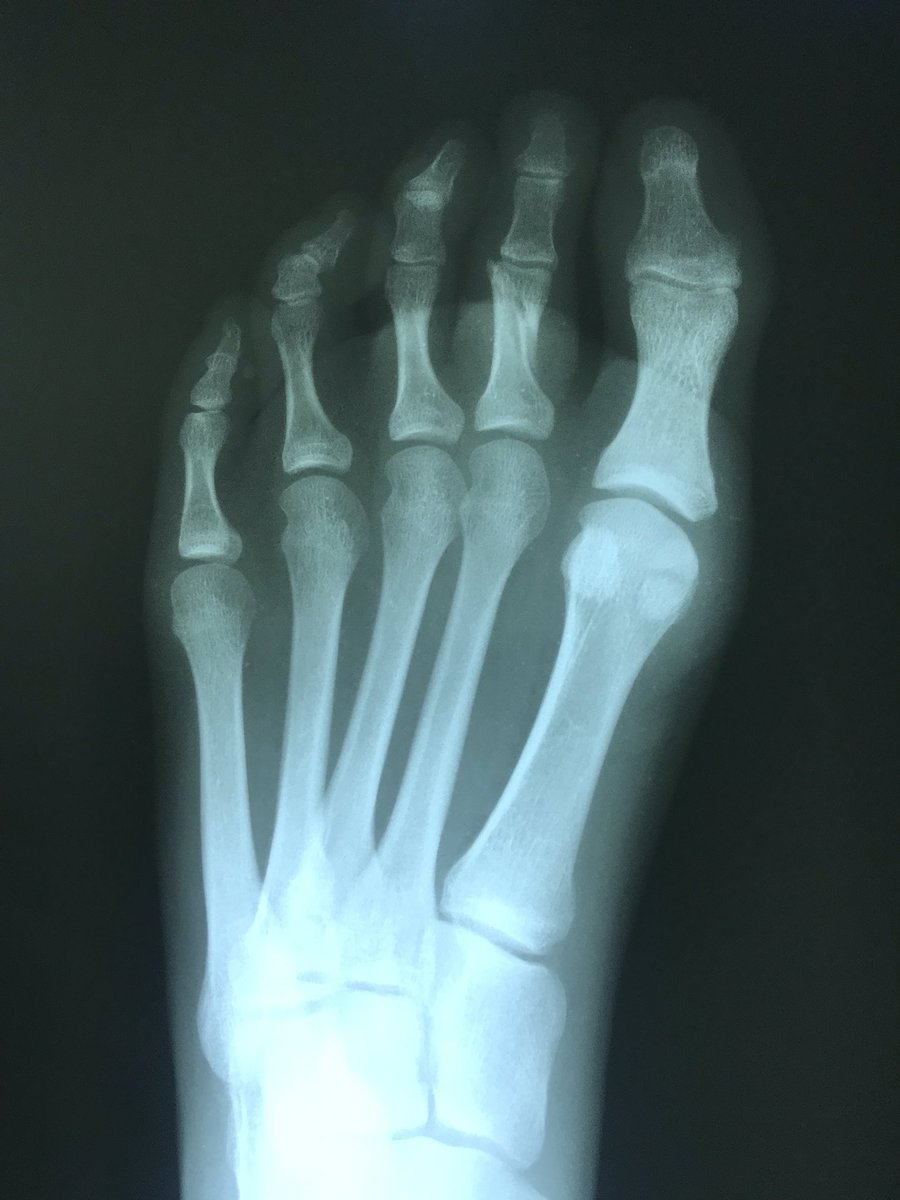 TamiCleary1's tweet photo. She’s a tough cookie. @ACUWBB @coachgoodenough @ErikDeRooACU @MaddieCleary3 has been playing ball with a broken toe since 4 days before the ACU basketball camp......and will keep playing. #julybasketball #nostops #staytough https://t.co/RWP9mkrER7