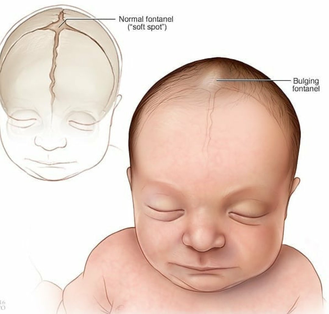 Родничок витамин. Родничок у новорожденных. Форма головы новорожденного. Родничок на голове у новорожденного.