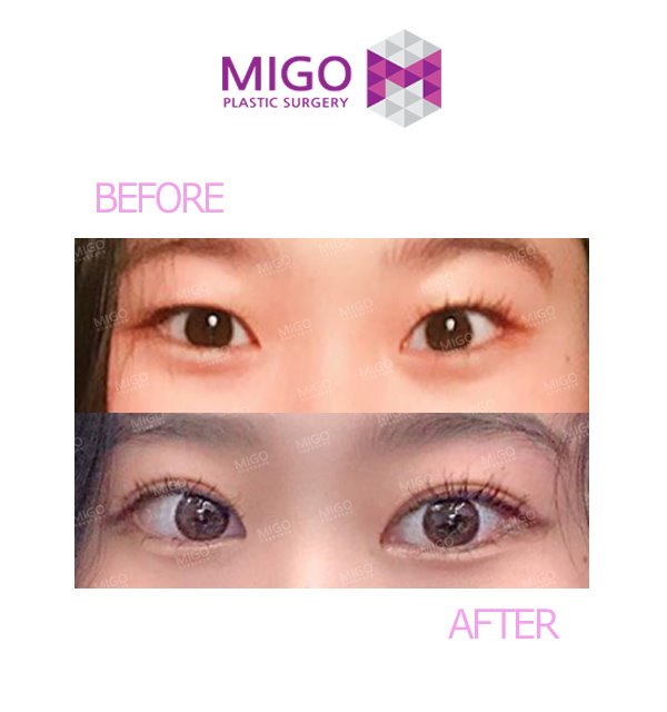 切開目付き矯正