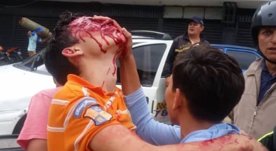 DipEdwinLuzardo's tweet photo. ¿Y así quieren seguir con la estupidez del diálogo? ¡Con asesinos no se diáloga! ¡Con estos desquiciados que han convertido al Estado en un epicentro de crímenes de lesa humanidad no se diáloga!

Rufo Velandria de apenas 16 años perdió ambos ojos,  protestaban por falta de gas. https://t.co/cWTVgwEXPT