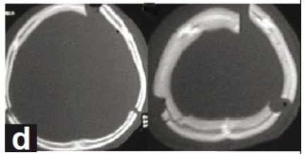 If you are a #neurosurgeon / trauma surgeon performing cranial surgery, please take part in our survey on #hinge #floating #craniotomy, supported by <a href="/WFNSHQ/">WFNS</a>

#neurosurgery #neurotrauma #nsgy #globalneurosurgery #globalneurotrauma

docs.google.com/forms/d/e/1FAI…