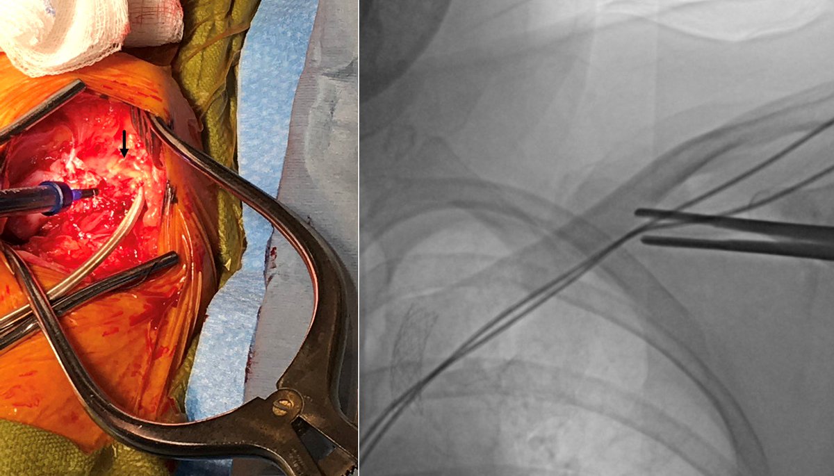 rdschaller's tweet photo. This is why it is a bad idea to use central access. Lead encased in bone. https://t.co/iz5Ca7EolX