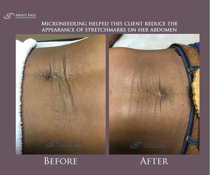 AFaceAntiAging's tweet photo. Microneedling isn't just for the face!  Look how it got rid of some stretchmarks!  Call or Text (254) 781-8169 for a free consultation  #Microneedling #EliminateStretchmarks #BuhByeScars https://t.co/f7hduzFPVd