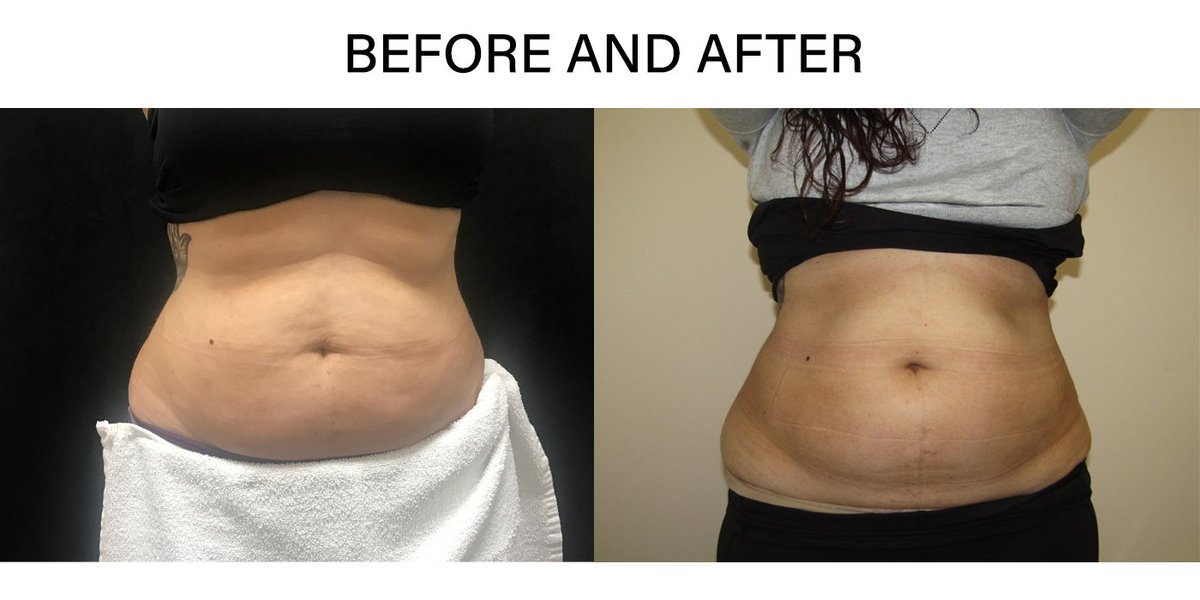 CanadaMedLaser's tweet photo. amazing @CoolSculpting results on the abdomen area on our gorgeous client! #coolsculpting #bodytransformation #transformationtuesday #tuesday #tuesdays #beauty https://t.co/TBMKKqbYLp