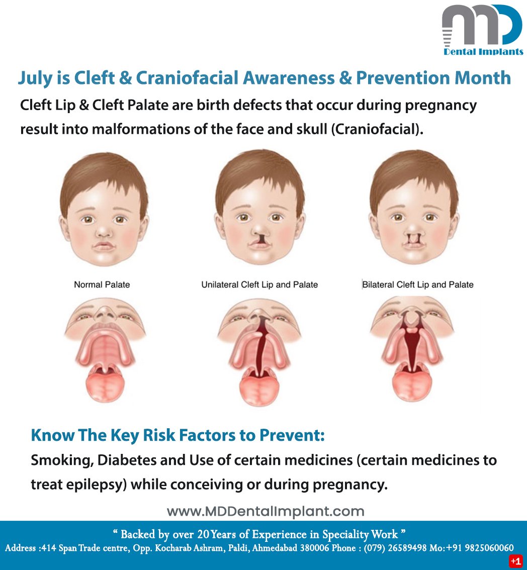 mddentalimplant's tweet photo. July is Cleft &amp; #Craniofacial Awareness &amp; Prevention Month

Cleft Lip &amp; Cleft Palate are birth defects that occur during pregnancy result into malformations of the face and skull (Craniofacial)

Know The Key Risk Factors to Prevent:
#Smoking #Diabetes &amp; Use of certain medicines https://t.co/JmROoPEpVA