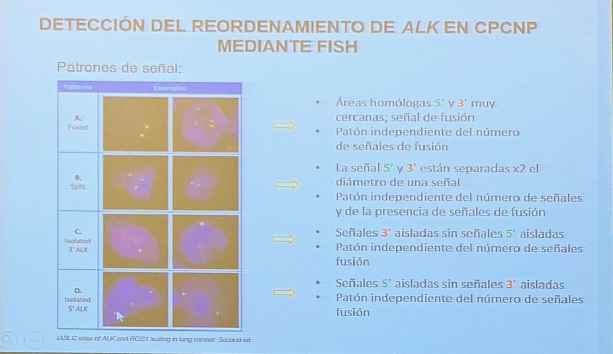 marta_msalido's tweet image. Detección de reordenamiento de ALK en pacientes con CPCNP #CodingLungCancer #powerFISH