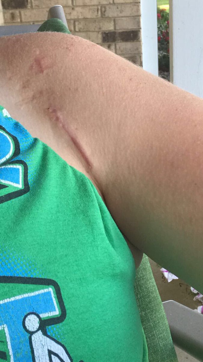 shoulderprobs's tweet photo. 1 year post op! https://t.co/piIEyPuyJJ
