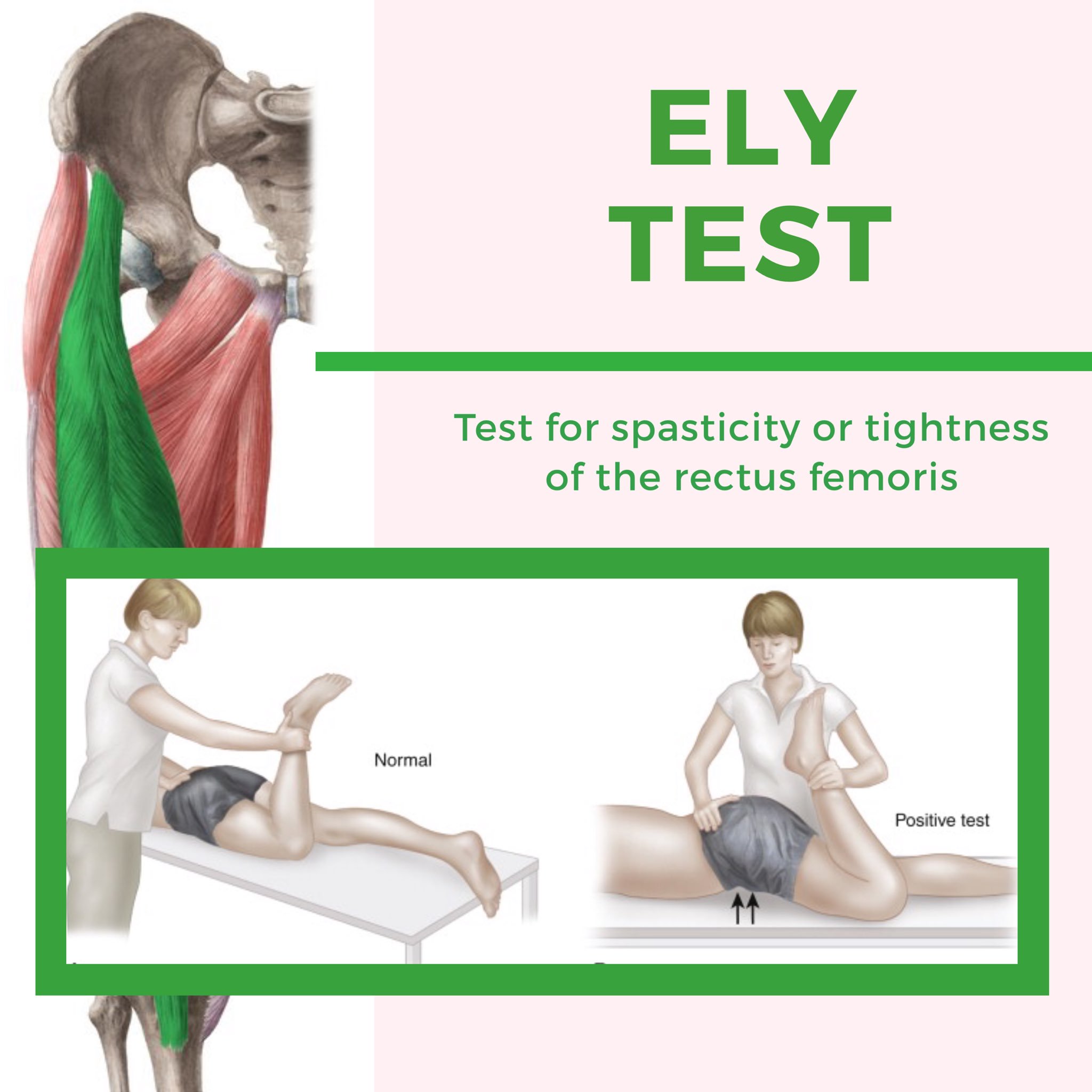 Rectus Femoris Contracture Test
